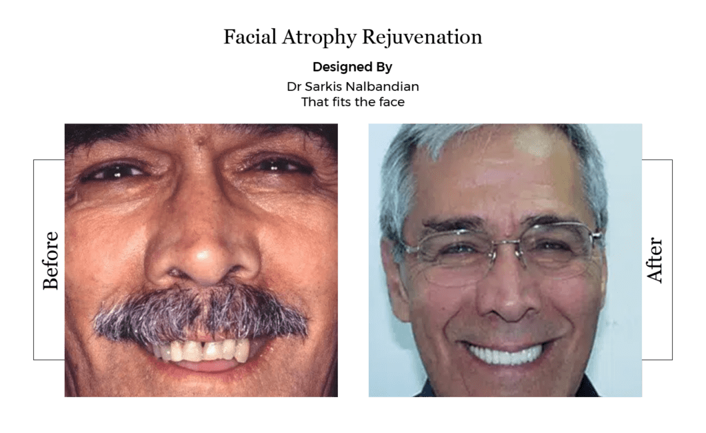 facial atrophy rejuvenation