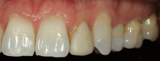 tooth image