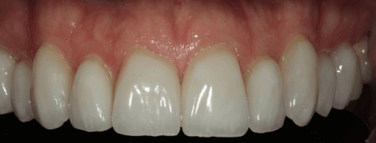 tooth image