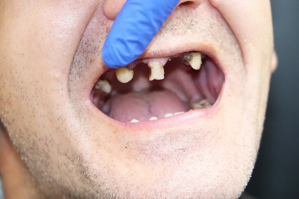 3 Replacement Teeth Options for When One or More Teeth are Missing