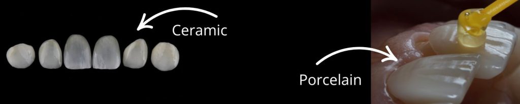 composite vs porcelain veneers