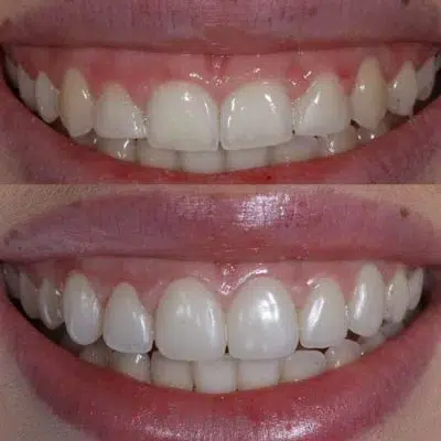 gum-lift-before-after-close-up-400x400