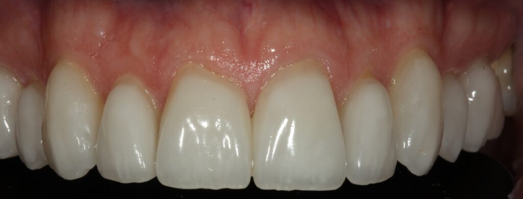 After Dental Veneers 2 - Designer Smiles