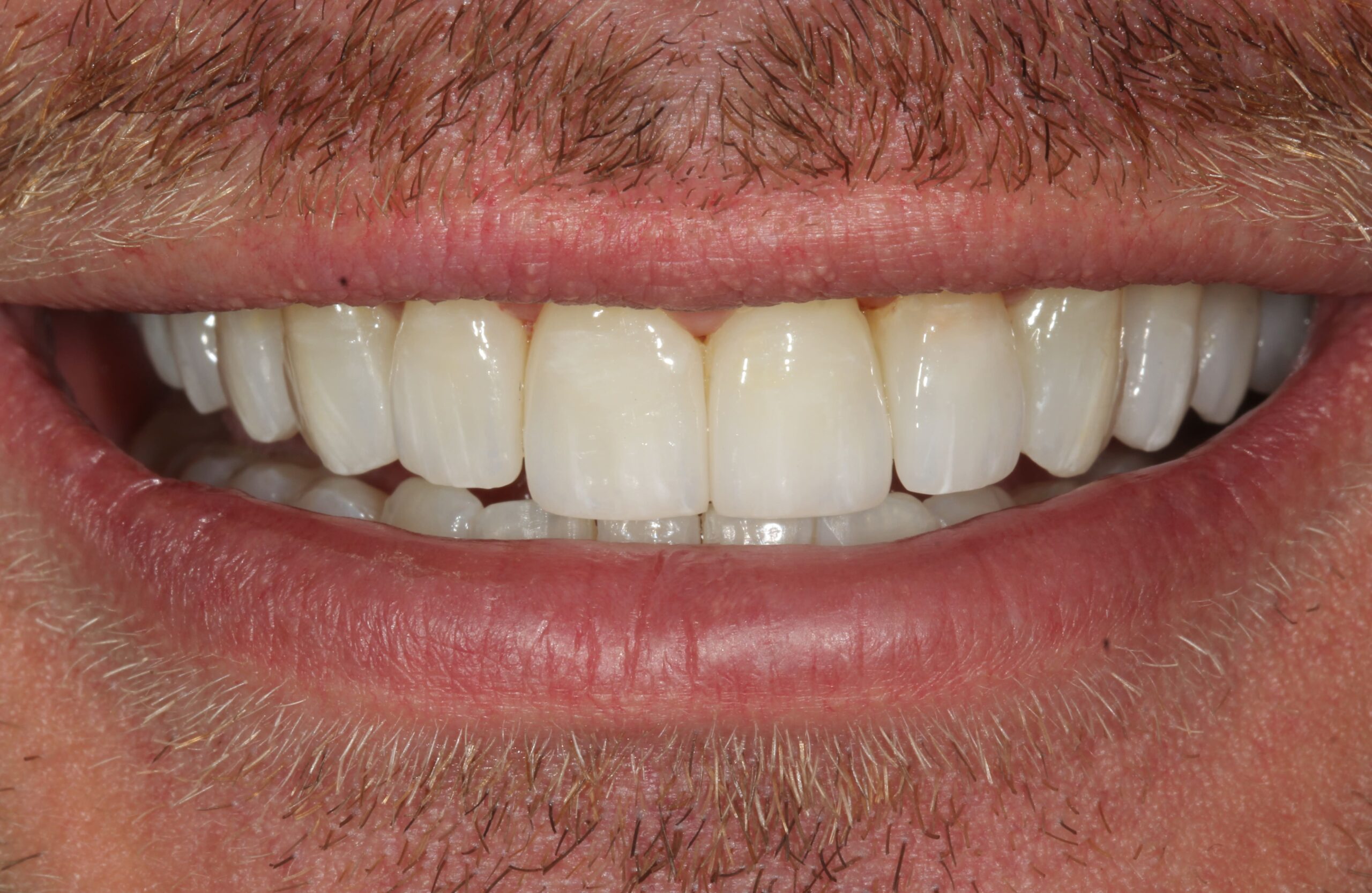 After Dental Veneers 1 - Designer Smiles