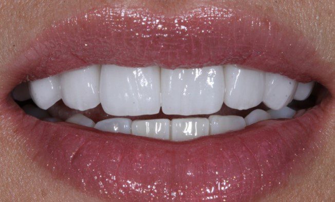 After Dental Veneers 3 - Designer Smiles