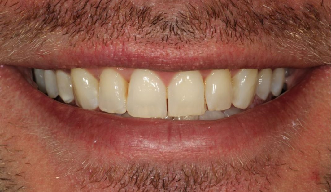 Before Dental Veneers 1