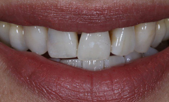 Before Dental Veneers 3