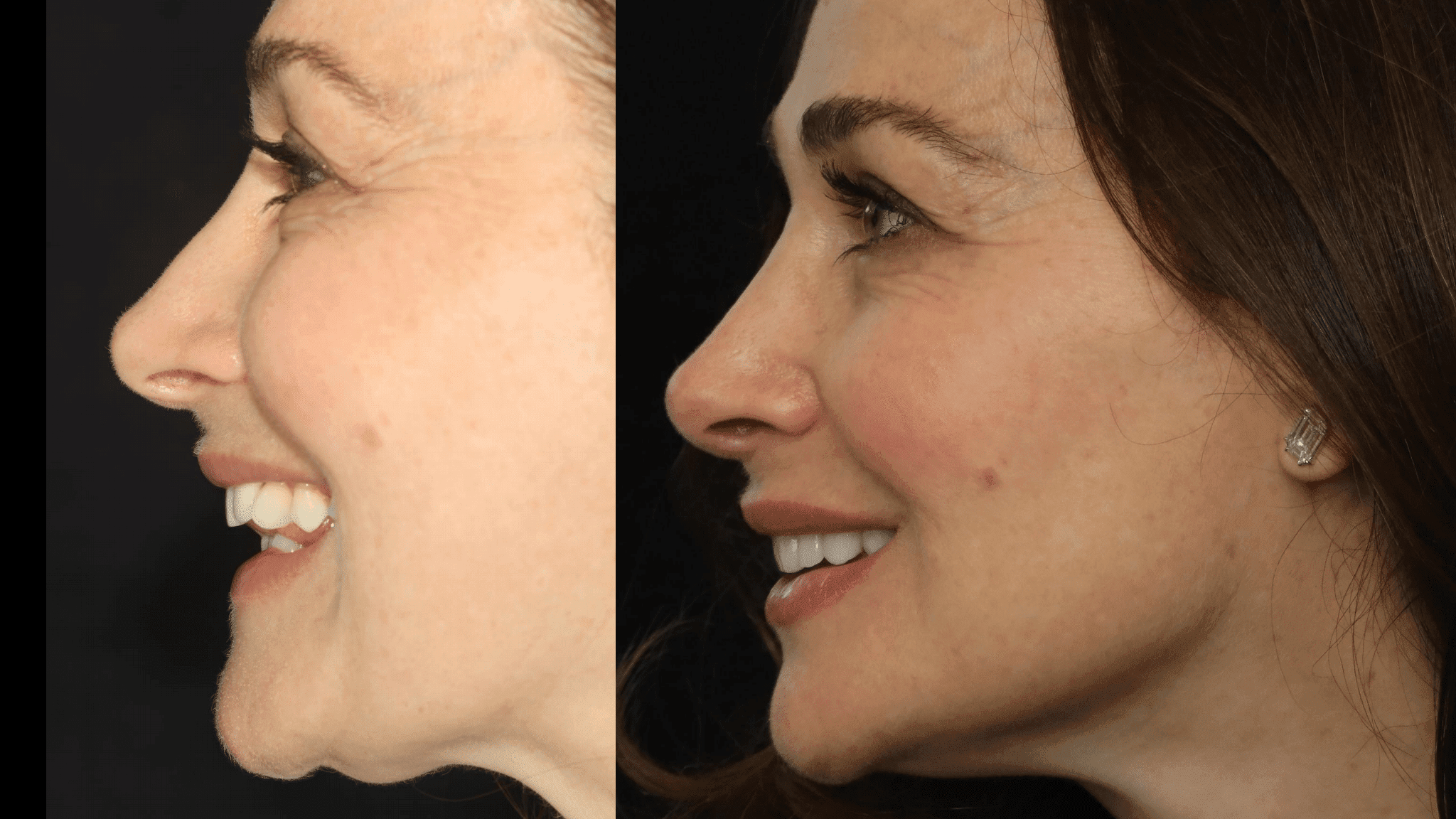 before and after dental veneers